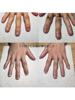 深爪でお悩みの方に