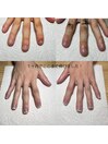 深爪でお悩みの方に