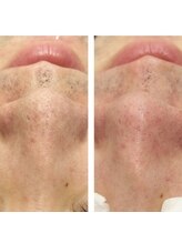 ハグ(hug)/メンズ毛穴洗浄