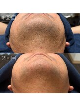 カナウ(KANAU)/ヒゲ脱毛（40代後半男性）
