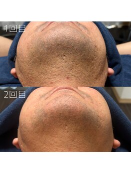 カナウ(KANAU)/ヒゲ脱毛（40代後半男性）