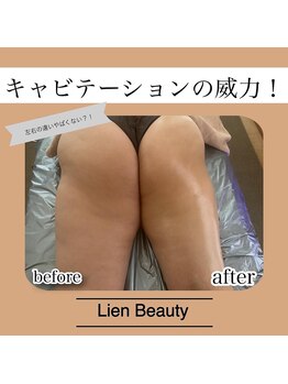 リアンビューティー(Lien Beauty)/キャビテーションで撃退!