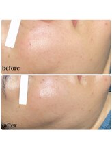 ちらちゅら/クリスティーナ【施術経過】