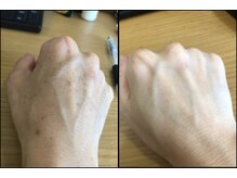 リッツ 草加店(Ritz)/【Before/After】腕のシミ改善