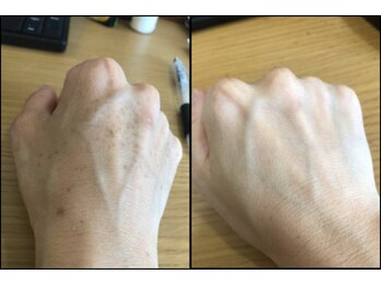 リッツ 草加店(Ritz)/【Before/After】腕のシミ改善