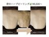 【リピート割】剥離なし★ソフト・ハーブピーリング背中7,500円→6,000円