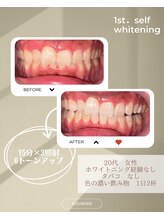 スリール(sourire)/ホワイトニング