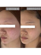 ホワイトアクア 鳳店(WHITE AQUA)/ハーブピーリング10回目