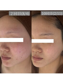 ホワイトアクア 鳳店(WHITE AQUA)/ハーブピーリング10回目