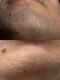 シューティングハーツ(SHOOTING HEARTS)の写真/【完全個室】ジメジメ期の蒸れ・肌荒れ対策に！ヒゲ全体脱毛￥3500★夏本番前に面倒な自己処理から解放！

