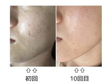 リモレア(RemoLe'a)/ニキビケア [リブセラ]