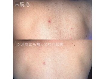 エピジュ(Epijyu)/男性の背中脱毛