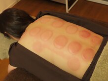 ケアケア(care×care)/カッピング