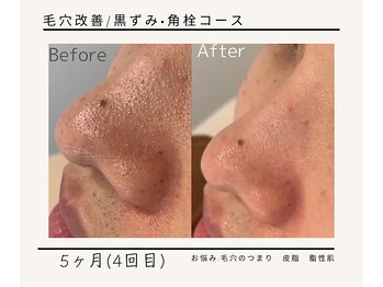 ルミエールフォートサイド(L’MIERE fortside)/お悩み:毛穴詰まり,皮脂,脂性肌