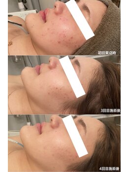 ビジュープラス 松本店(Bijou+)/ハーブピーリング