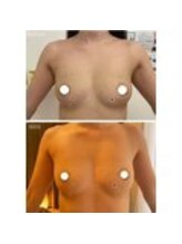 美人バスト 表参道店/【バストアップ/育乳 症例】☆