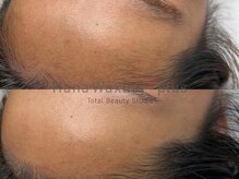 ハナワクシングプラス 高知(HanaWaxing+)/【フェイシャルワックス】