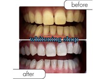 ホワイトニングショップ 鳳店の雰囲気(回数券人気No1☆10回コースBefore/After)