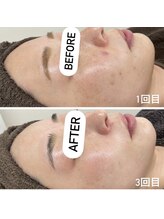 カルディエ(Cardie)/肌質改善　ビフォーアフター