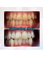 ホワイトニングショップ 鳳店/回数券人気No.1★10回コース