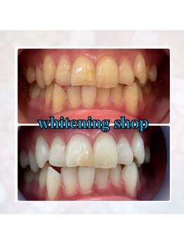 ホワイトニングショップ 鳳店/回数券人気No.1★10回コース