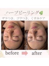 ナルシス(Narcissus) 肌質改善 美肌