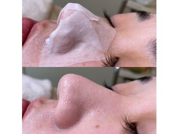 リンド エステ まつげ 京成大久保(Lind)/毛穴洗浄×シェービング