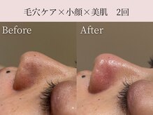 ミア(miiia)/毛穴ケア×小顔×美肌