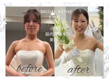 アモリール(Amolir)/ブライダル小顔ビフォーアフター