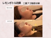 頭のオアシすぱ/ハイドラ+レモンボトル効果　1