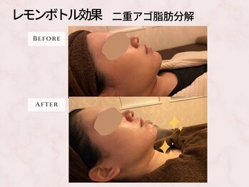 頭のオアシすぱ/ハイドラ+レモンボトル効果 1