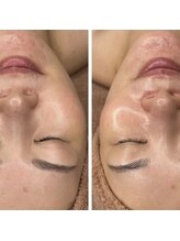 ブルーム(bloom)/ハーブピーリング/ララピール