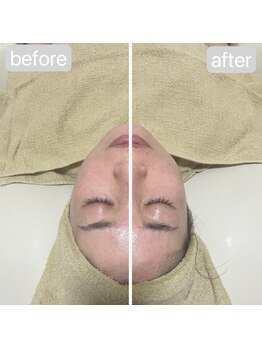 エイル ビューティ ホヌ(EIL beauty Honu)/ハイドラ&エアバリ+美容液導入