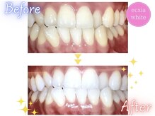 エクシアホワイトニング 郡山店/ホワイトニングビフォーアフター