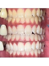 ペルレ(Perl)/本格ホワイトニング経過