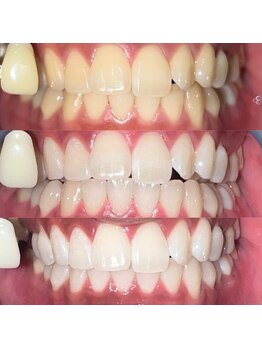 ペルレ(Perl)/本格ホワイトニング経過