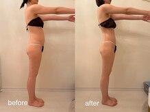 クロレ 浦和店(CLORE)/20代のお客様/4回施術