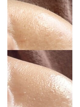 プライベートサロン アール(R)/FWT（顔脱毛）