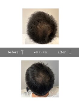 青空 天神大名店(SORA)/マイクロチップ頭皮 &nbsp;4回