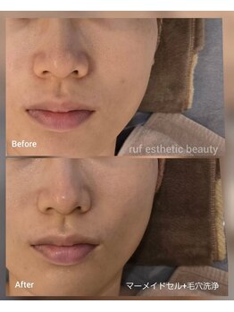 ルフ エステティック ビューティー(ruf esthetic beauty)/マーメイドセル