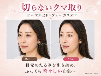 オリエンタルローザ 表参道(Oriental Rosa)/切らないクマ取りで目元の影解消