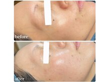 ちらちゅら/クリスティーナ【施術経過】