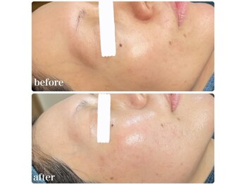 ちらちゅら/クリスティーナ【施術経過】