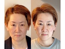 小顔22 ボルティ 本店(Bolty)/Before→After（10回目）