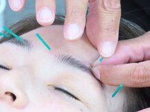 ことぶき整骨院/鍼