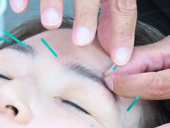 ことぶき整骨院/鍼