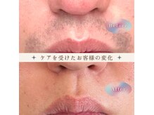 オフ(off)の雰囲気（鼻下ヒゲ脱毛１０回印象劇的変化！清潔感UP♪）