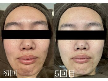 チャマ 高知店(CHAMA)/30代 水光ピール 透明感アップ