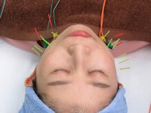 セキ鍼灸院/美容鍼2