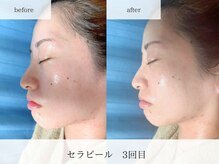 ビー(Be.)/セラピール3回の効果